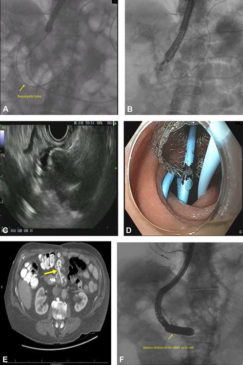 Eus Guided Jejuno Enterostomy In A Patient With Total Gastrectomy With