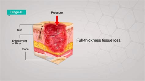 Pressure Ulcer Diagram