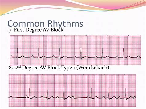 12 Lead Ekg Interpretation Ppt