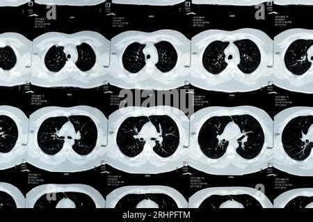 Multi Slice Ct Scan Of The Chest Showing Normal Study Normal