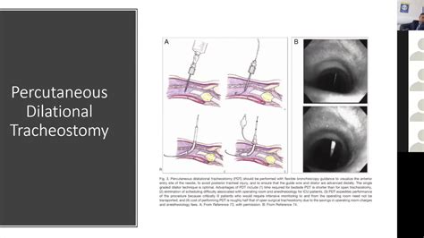 Complications Of Tracheostomy And Tracheal Surgery Sam Majumdar Youtube