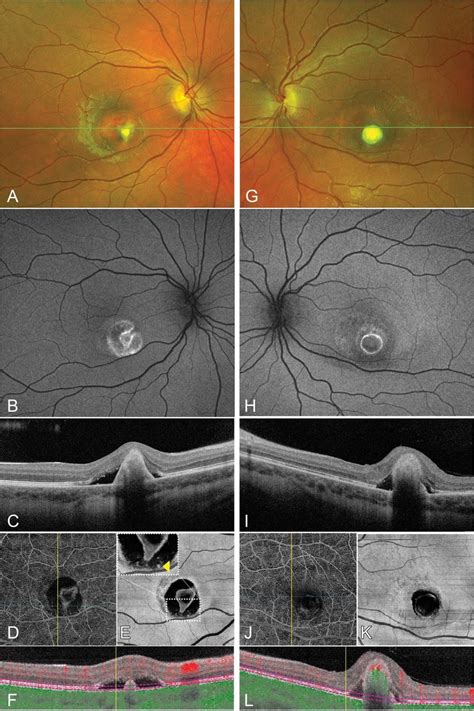 Multimodal Imaging Including Cfp Faf Sd Oct And Oct A Of Macular