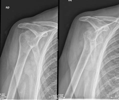 Shoulder X-ray revealing an irregular humeral head, with a bone defect... | Download Scientific ...