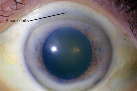 Arcus senilis causes, signs, symptoms, diagnosis & treatment