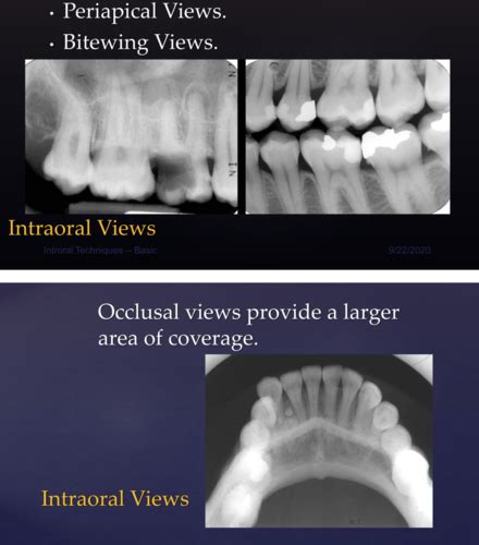 Intraoral Radiographic Techniques Flashcards Quizlet