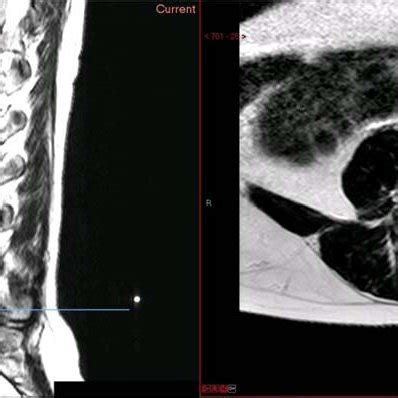 Preoperative MRI scan of the lumbar spine: preoperative MRI scan of the ...