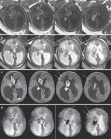 Figure 2 From Fetal Germinal Matrix And Intraventricular Hemorrhage