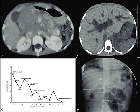 A Computed Tomography Of The Abdomen Showing Large Lobulated Mass