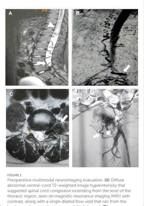 PDF Endovascular Treatment Of Epidural Arteriovenous Fistula