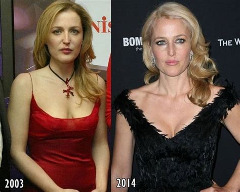 The Right Kind of Changes from Gillian Anderson’s Plastic Surgery | Go ...