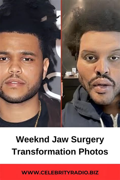 Weeknd Jaw Surgery Transformation Photos Jaw Surgery Plastic Surgery Celebrity Plastic Surgery