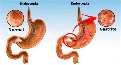 Gastrite Sintomas Causas E Tratamento