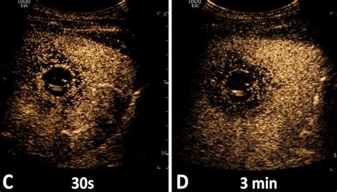 Amoebic Liver Necrosis In Contrast Enhanced Ultrasound [november 2023