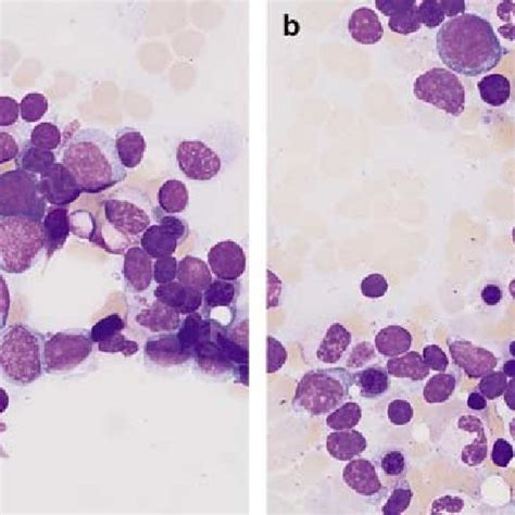 Sirs A For Familial History Of Hodgkins Lymphoma By Age And Sex Download Table