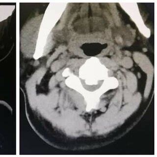 Summary Of Surgical Approaches To OPLL And Their Associated Advantages