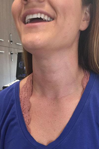 Goiter Removal