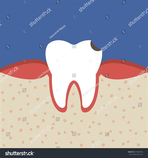 Vektor Stok Tooth Sectional View Decay Human Caries Tanpa Royalti