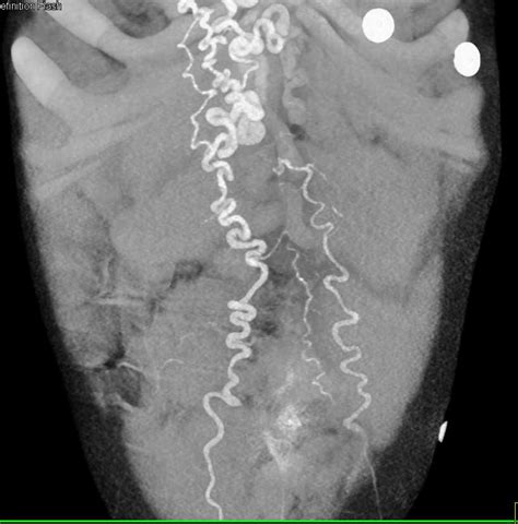 Cirrhosis With Portal Hypertension And Varices And Splenomegaly Liver