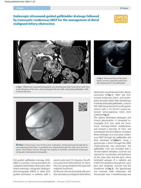 PDF Endoscopic Ultrasound Guided Gallbladder Drainage Followed By