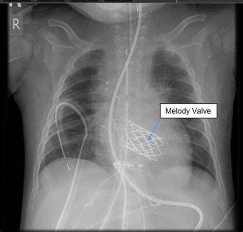 Mitral Valve Replacement In Neonatal Endocarditis Time To Discuss