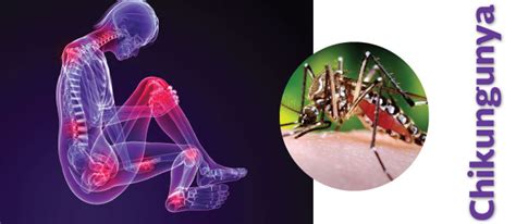 Sintomas De Chikungunya