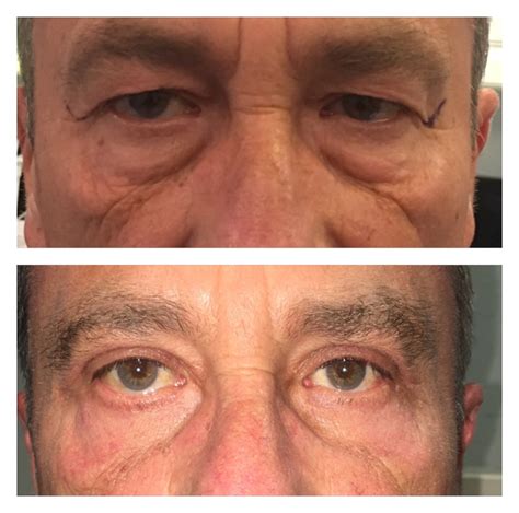 Blepharoplasty Eyelid Surgery Assil Gaur Eye Institute