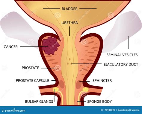 Second Stage Of Prostate Cancer The Tumor Is Big And Located In