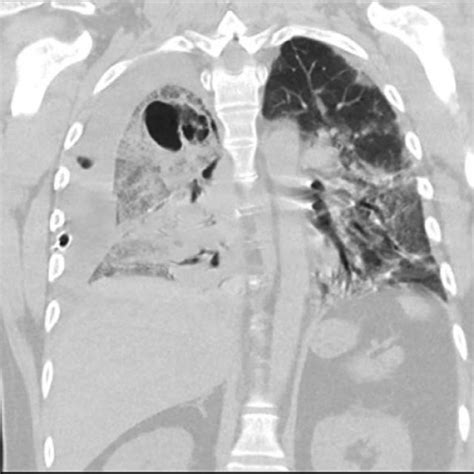 -Coronal view of CT chest confirming the cavitary lesion and persistent ...