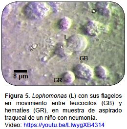 Infección del tracto respiratorio humano por Lophomonas spp