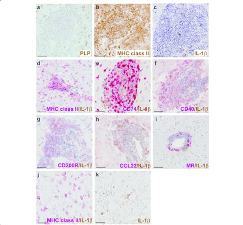 IL 1β expression in perivascular infiltrates in active MS lesions