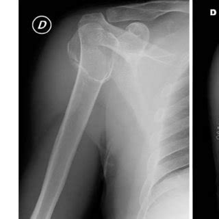 Proximal humeral fracture before and after surgical treatment ...