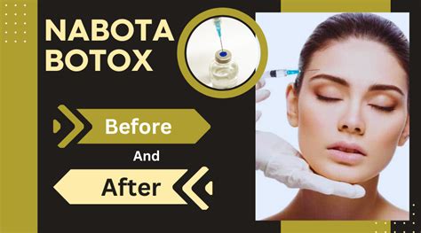 Nabota Botox Before And After