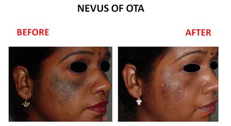 Nevus Of Ota Amrit Clinic