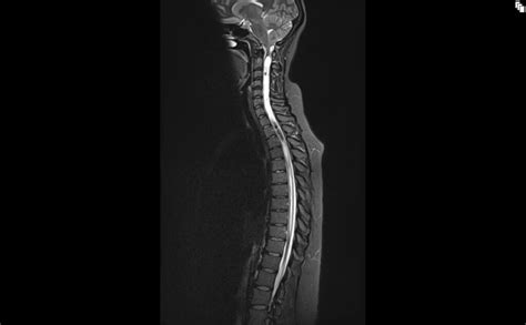 Syringomyelia MRI | Radiology article on syrinx