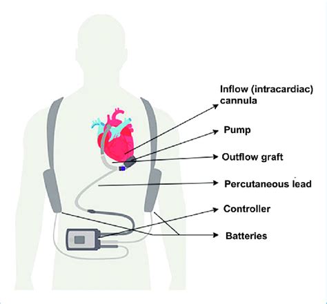 Components Of Left Ventricular Assist Devices Adapted From