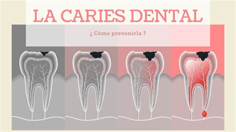 La caries dental y su prevención Perioalcorcón