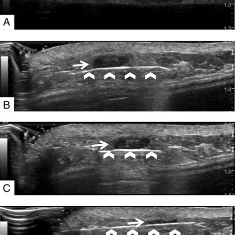 Preoperative View Showing The Preoperative Markings For A Patient Download Scientific Diagram