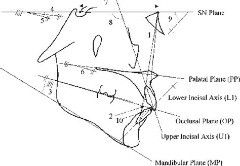 Figure 1 From Properties Of The Anb Angle And The Wits Appraisal In The Skeletal Estimation Of