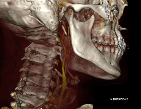 Traumatic Atlantoaxial Rotatory Subluxation : r/Radiology