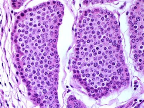 Terminal Ileum Carcinoid Well Differentiated Neuroendocrine Tumor