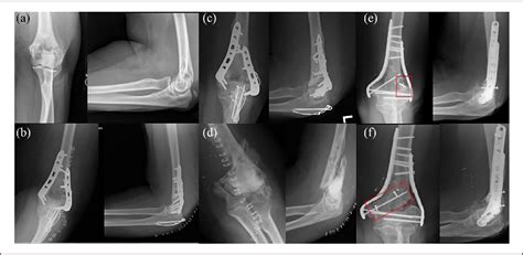 Figure From The Medial Femoral Condyle Free Flap An Excellent Option