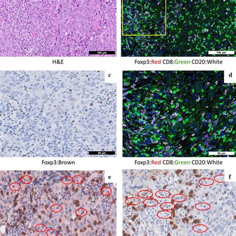 Cd T Cells And Cd Foxp Tregs Infiltrate The Tumour Nest And Stroma