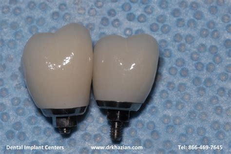 Molar Implant Teeth | San Diego Dental Implant Centers