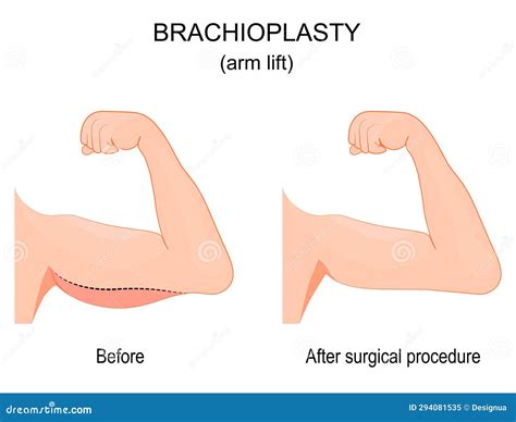 Brachioplasty Before And After Surgical Procedure Stock Vector