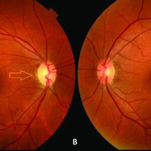 Color Fundus Photographs Of Patient S Right A And Left B Eyes In