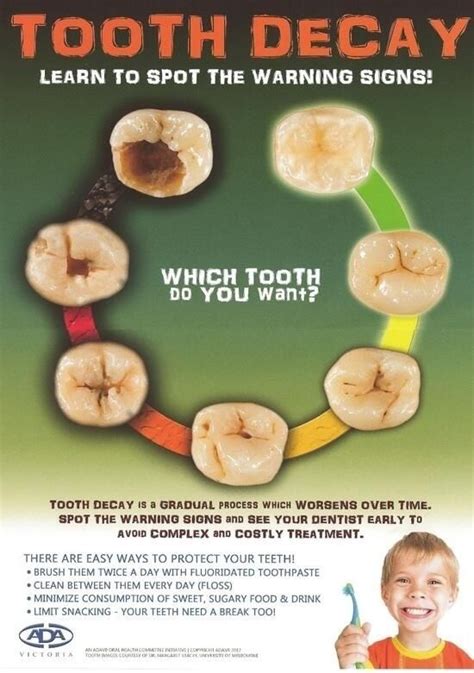 A Diagram Showing The Stages Of Formation Of Cavity Dental World