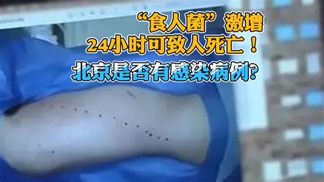 “食人菌”激增，24小时可致人死亡！北京是否有感染病例？北京时间