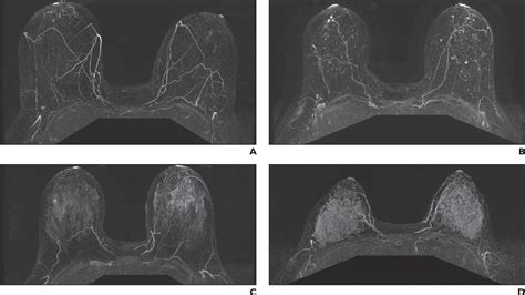 Background Parenchymal Enhancement On Breast Mri Impact On Diagnostic