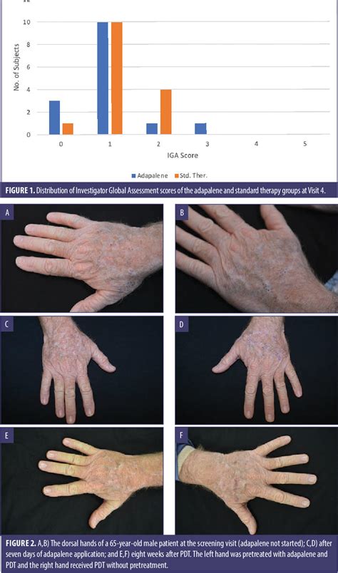 Figure From Photodynamic Therapy For Actinic Keratoses Of The Upper