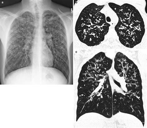 Pediatric Diffuse Lung Disease Radiology Key